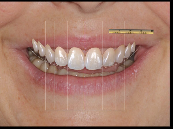 ¿Qué es el Diseño Digital de Sonrisa (DSD)?