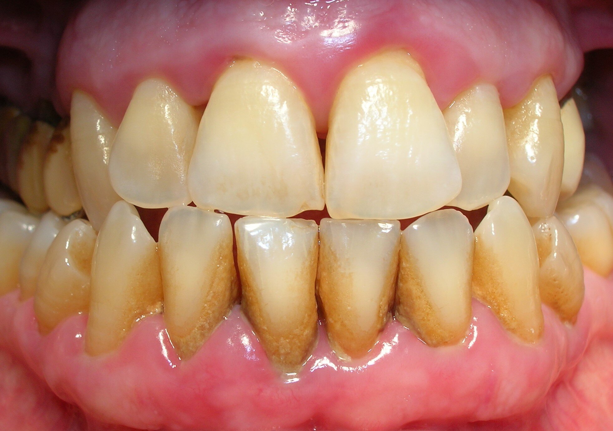 ¿Qué es el Sarro y por qué es Perjudicial?