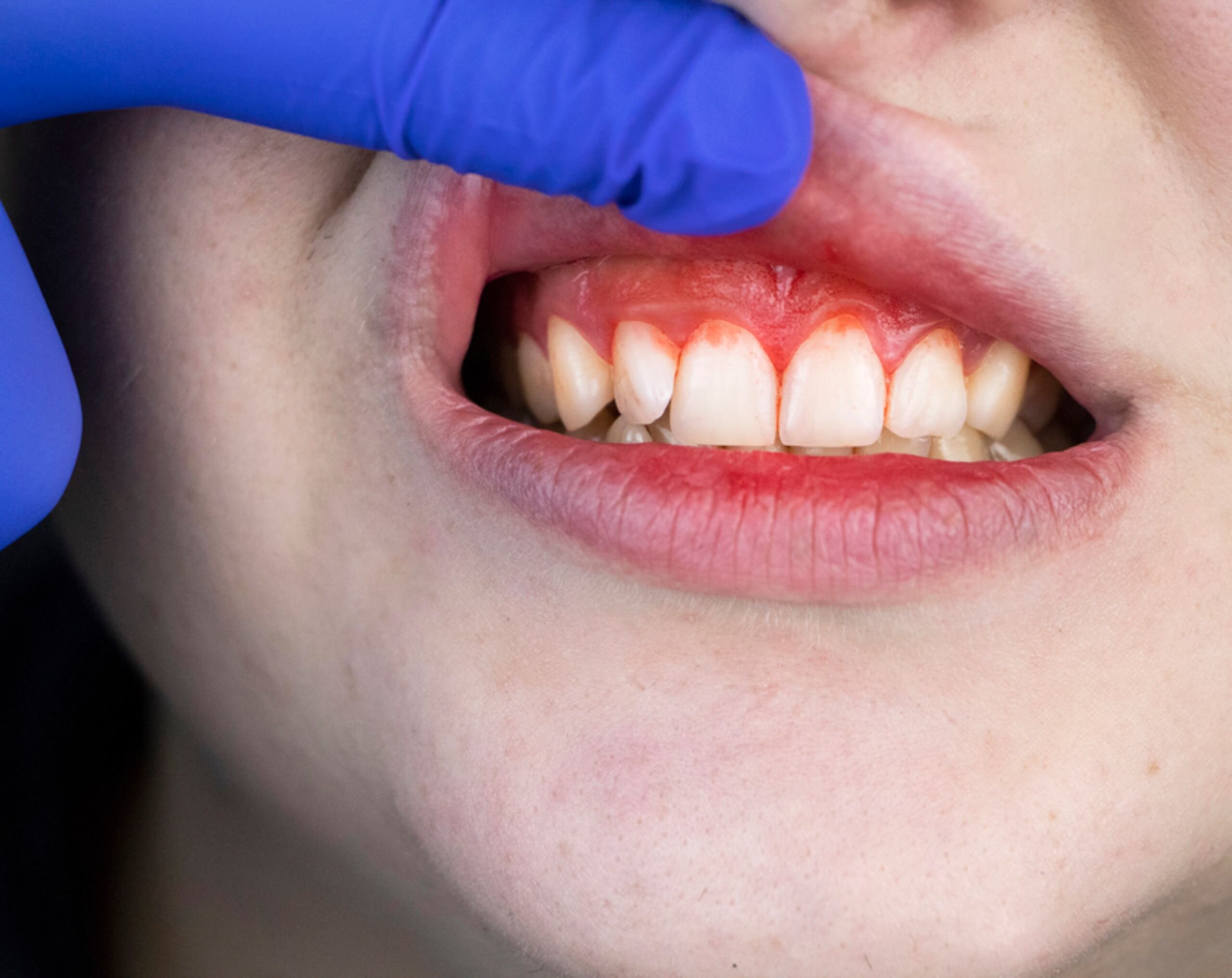 ¿Qué es la Gingivitis y por qué es importante tratarla?