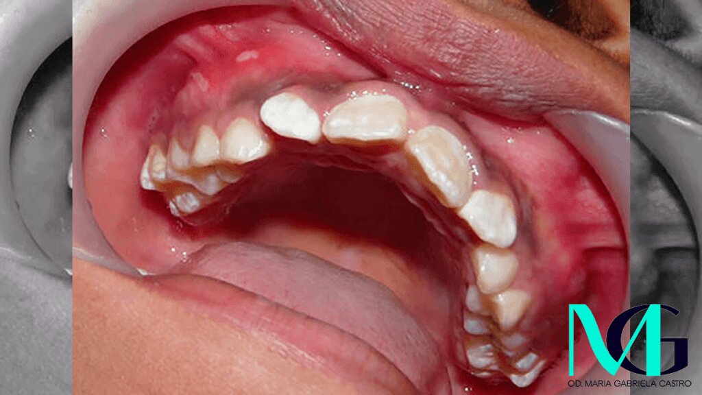 ¿Qué son las Aftas y Por Qué son Recurrentes en Niños?