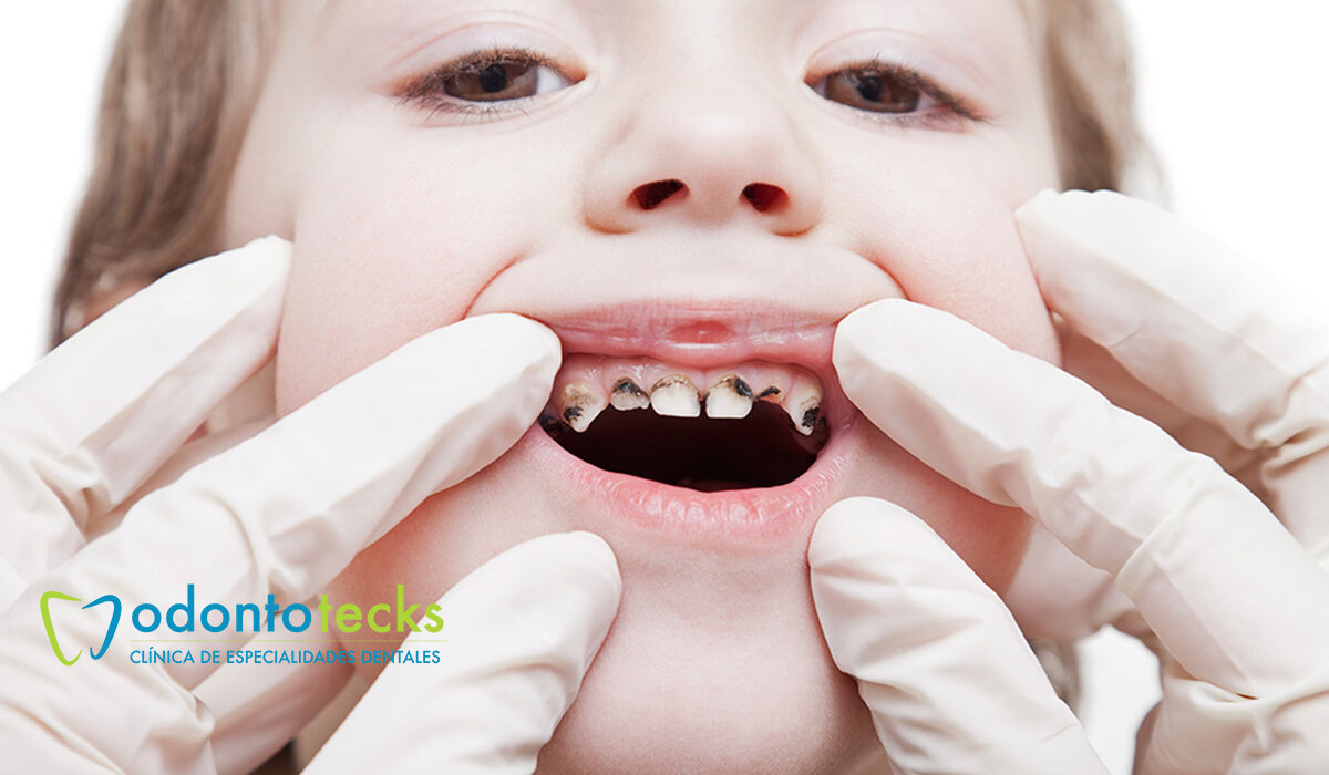 ¿Qué son las Caries en Niños y Por Qué Ocurren?