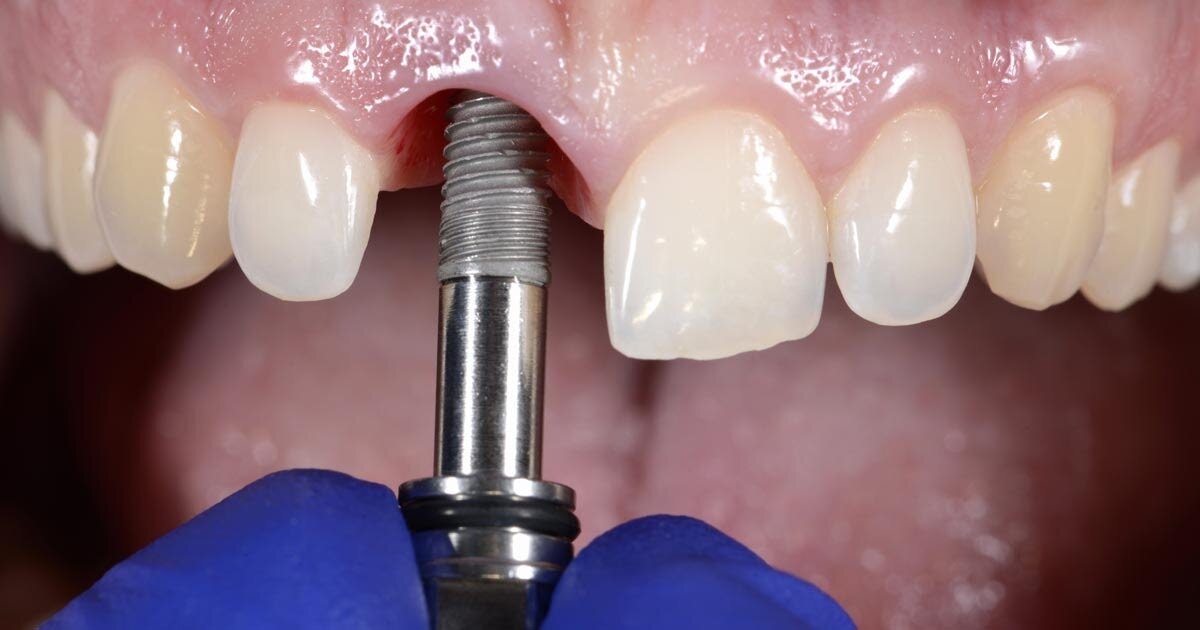 ¿Qué son los Implantes Dentales Múltiples?