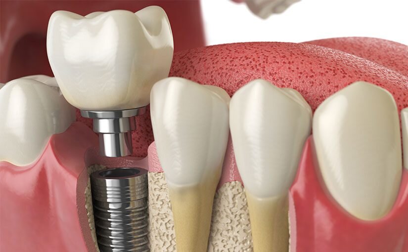 ¿Qué son los implantes inmediatos?