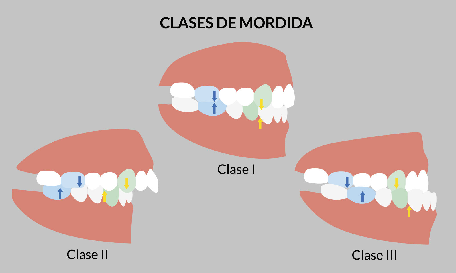 ¿Qué son los Problemas de Mordida (Maloclusiones)?