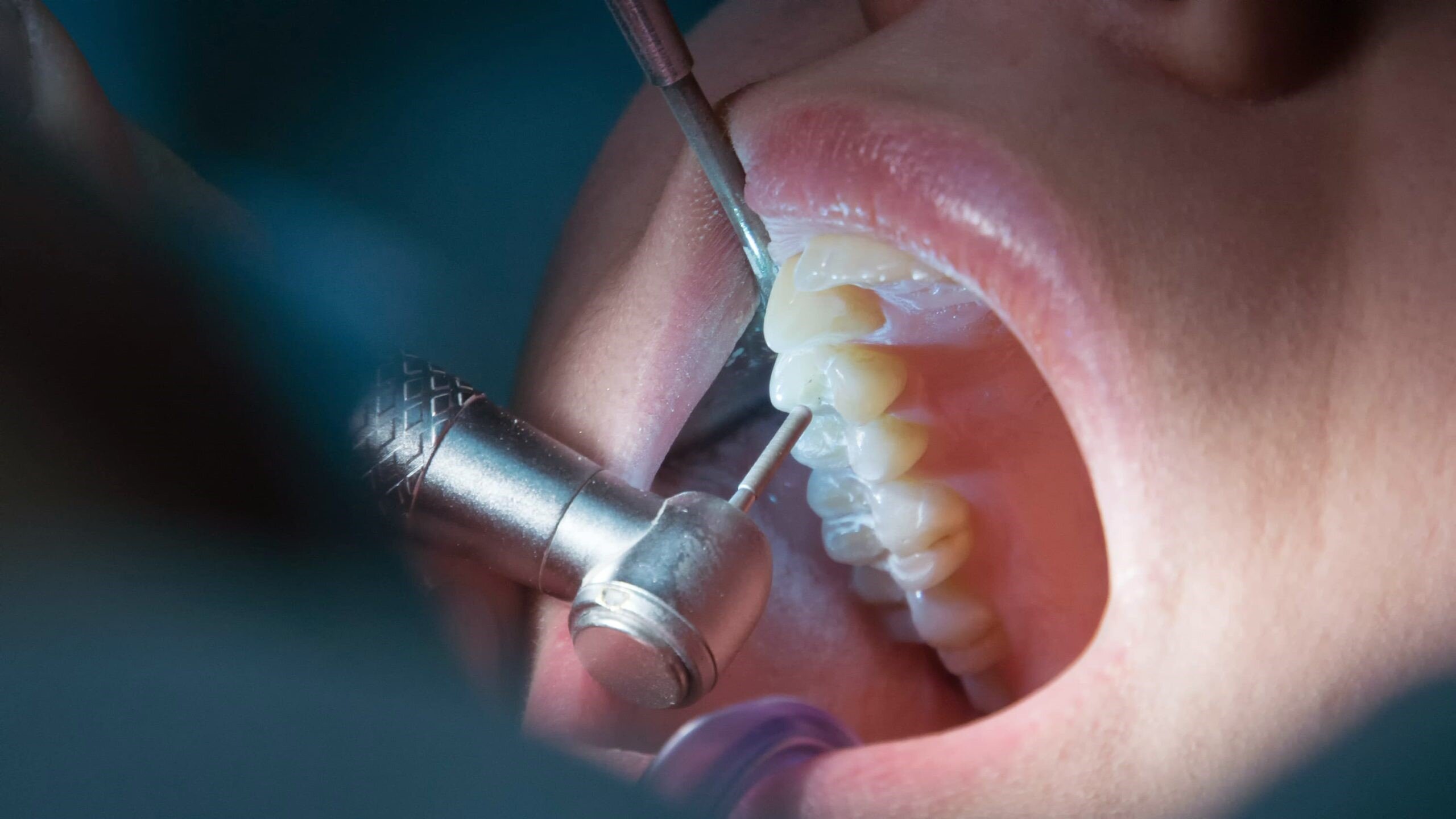 Tabla de Cuidados Post-Endodoncia
