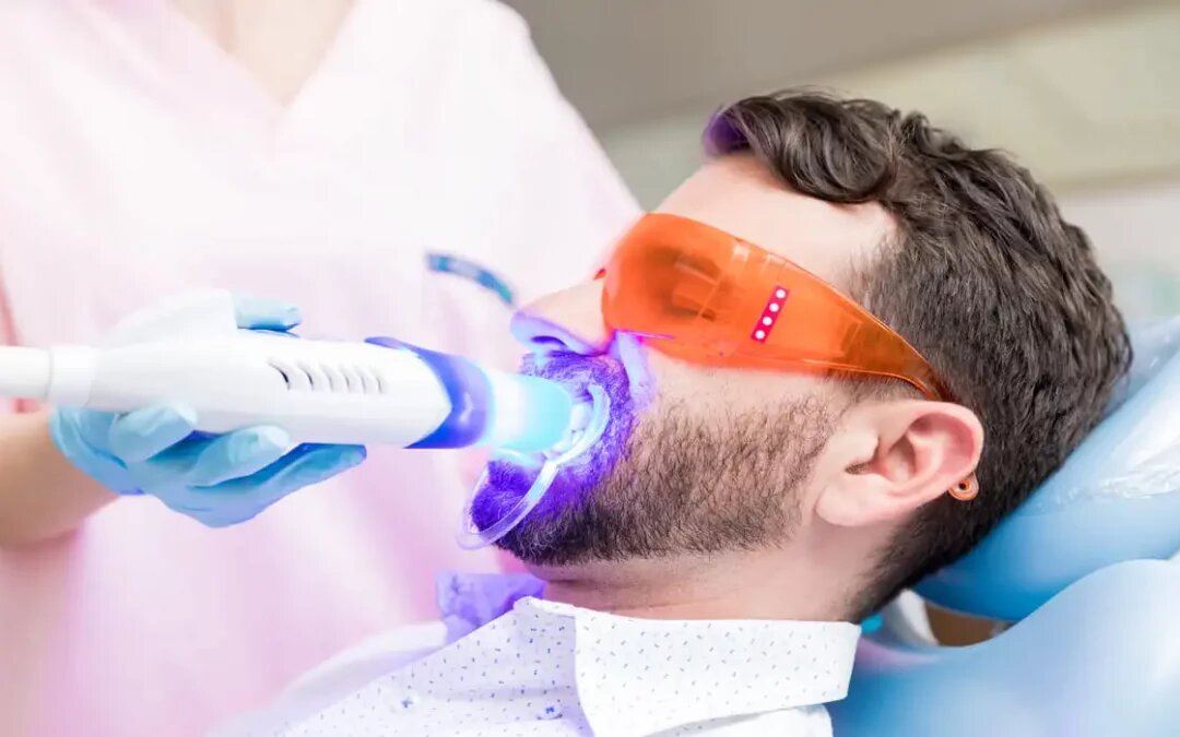 Técnicas de Blanqueamiento Dental Profesional