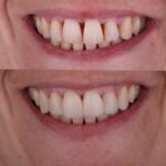 Tratamiento dental con resinas estéticas: ventajas, cuidados y medicinas posteriores necesarias