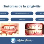 Tratamiento dental contra gingivitis crónica y medicinas más recomendadas en odontología