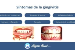 Tratamiento dental contra gingivitis crónica y medicinas más recomendadas en odontología