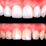 Tratamiento dental estético contra manchas dentales y medicinas recomendadas