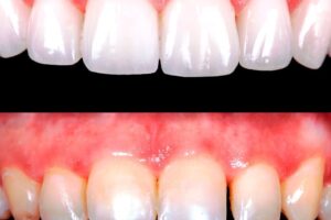 Tratamiento dental estético contra manchas dentales y medicinas recomendadas