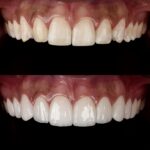 Tratamiento dental estético para mejorar sonrisa y medicinas más utilizadas en odontología