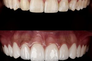 Tratamiento dental estético para mejorar sonrisa y medicinas más utilizadas en odontología