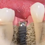Tratamiento dental integral con implantes y medicinas más recomendadas
