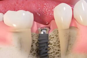 Tratamiento dental integral con implantes y medicinas más recomendadas