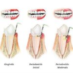 Tratamiento dental integral contra periodontitis y medicinas más recomendadas