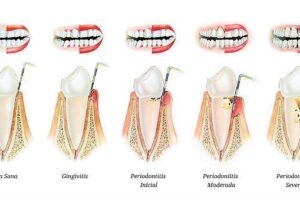 Tratamiento dental integral contra periodontitis y medicinas más recomendadas