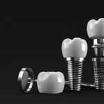 Tratamiento dental moderno con implantes inmediatos y medicinas recomendadas