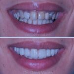 Tratamientos dentales con carillas de porcelana y medicinas necesarias en la recuperación