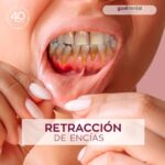 Tratamientos dentales con cirugía estética de encías y medicinas recomendadas