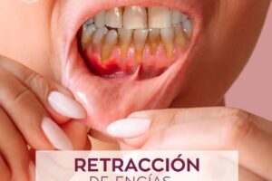 Tratamientos dentales con cirugía estética de encías y medicinas recomendadas