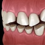 Tratamientos dentales contra bruxismo y medicinas necesarias para recuperación