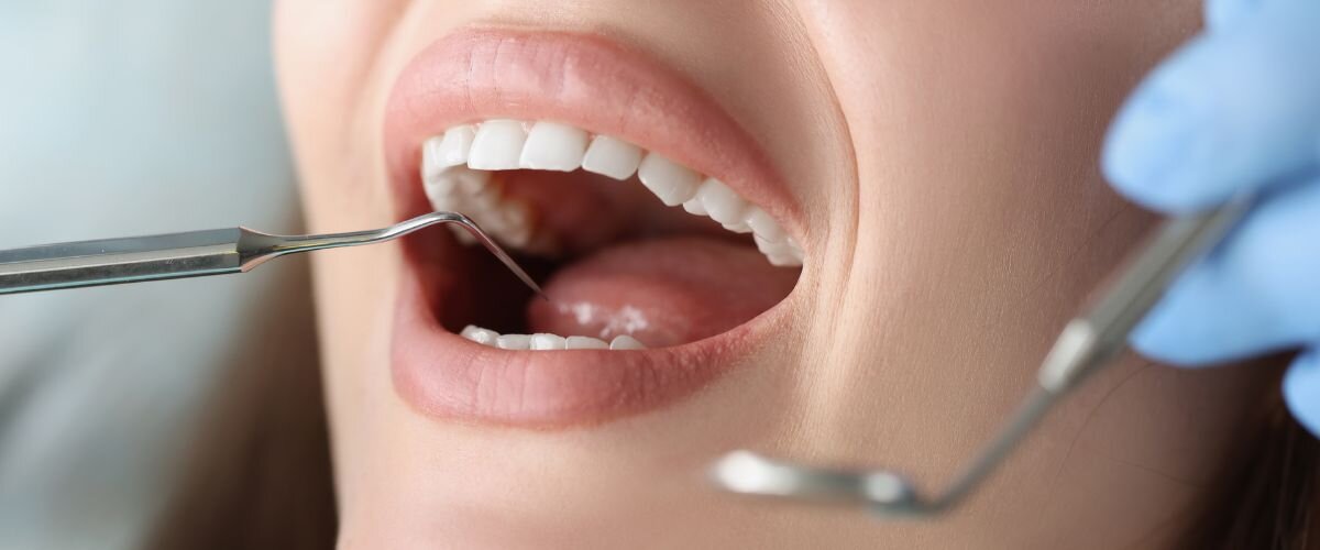 Tratamientos Dentales Efectivos para Aftas Recurrentes