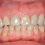 Tratamientos dentales efectivos para frenar el desgaste del esmalte y medicinas recomendadas