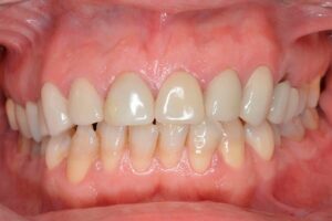 Tratamientos dentales efectivos para frenar el desgaste del esmalte y medicinas recomendadas