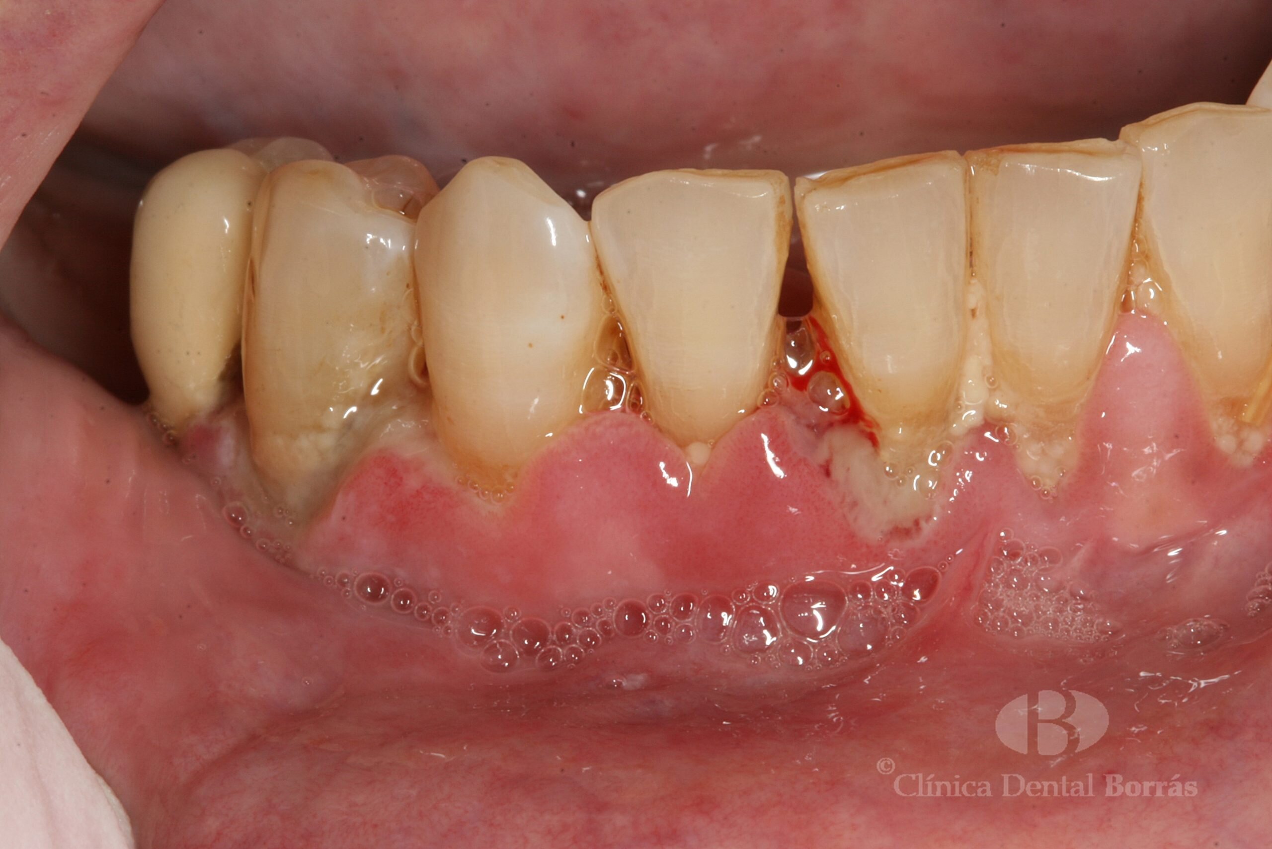 Tratamientos dentales efectivos para la gingivitis