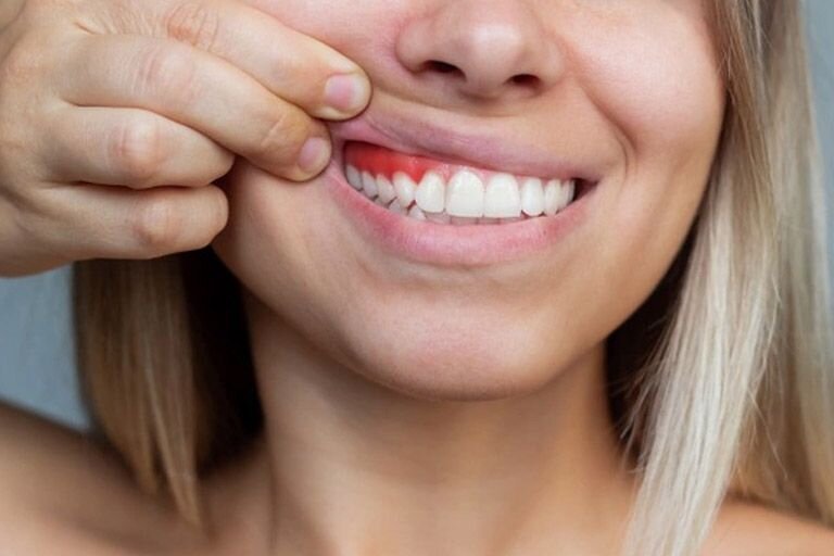 Tratamientos Dentales Más Efectivos para Encías Retraídas