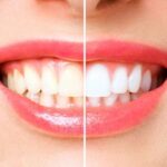 Tratamientos dentales para dientes manchados: opciones estéticas, cuidados y medicinas necesarias