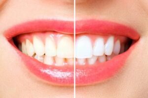 Tratamientos dentales para dientes manchados: opciones estéticas, cuidados y medicinas necesarias