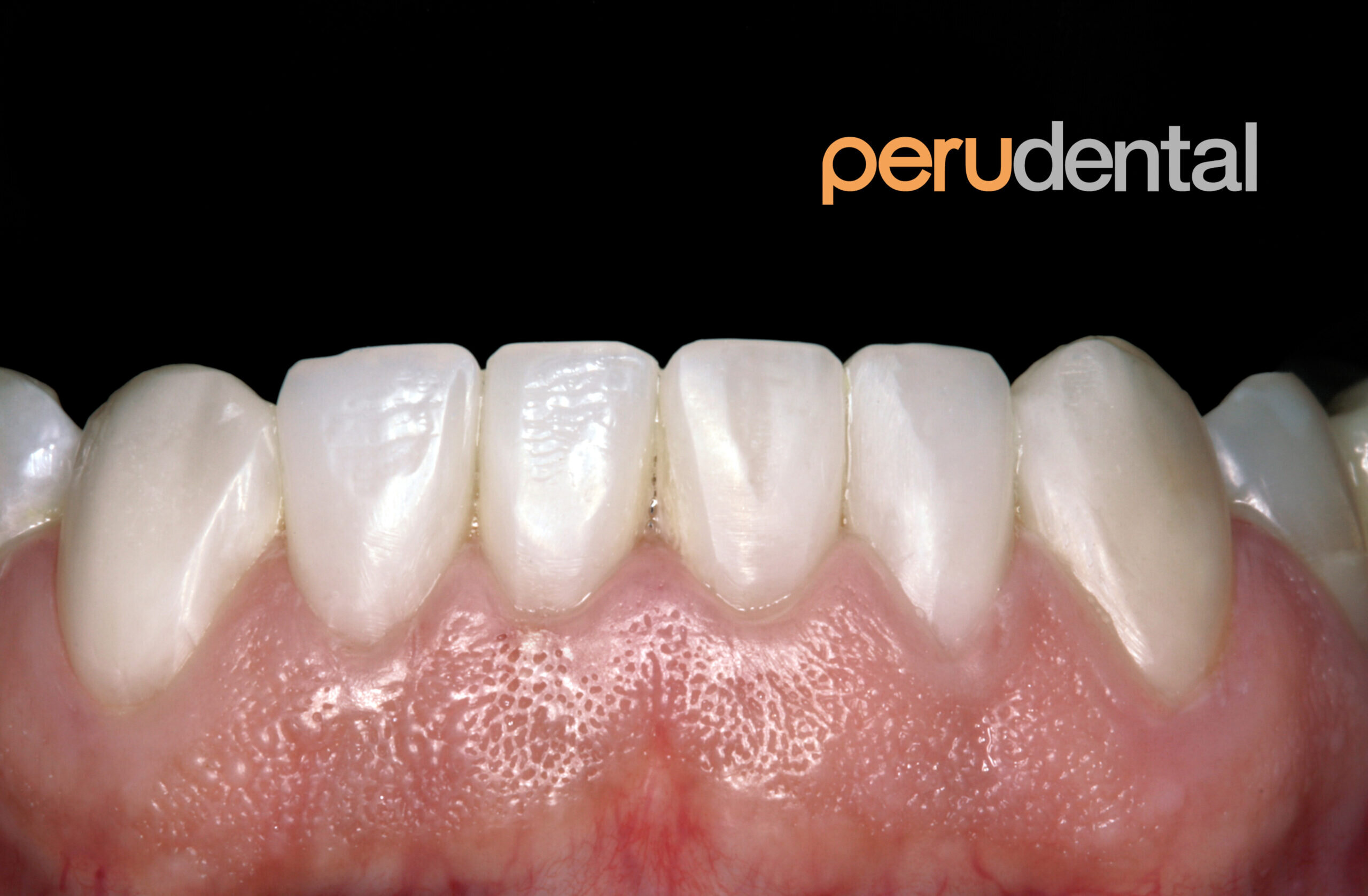 Tratamientos Recomendados para Infecciones Dentales